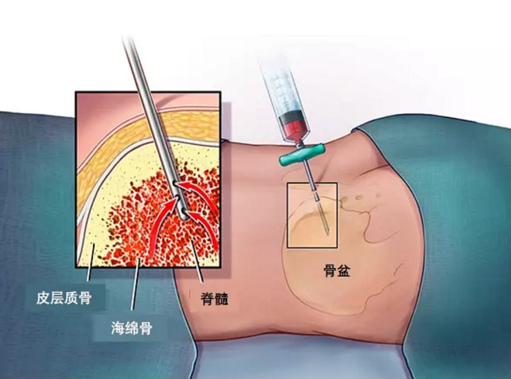 穿刺針衝壓廠家